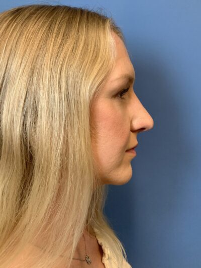 Rhinoplasty
