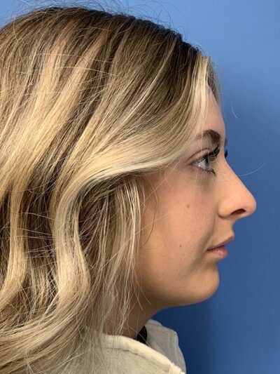 Rhinoplasty Case 37593 Before Photo Rhinoplasty