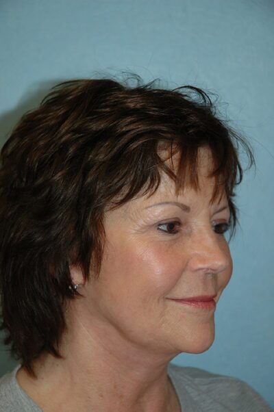 Face & Neck Lift Case 153 After Photo Face & Neck Lift