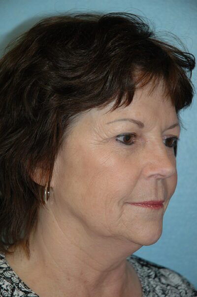 Face & Neck Lift Case 153 Before Photo Face & Neck Lift