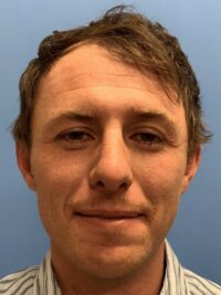 Chin Augmentation