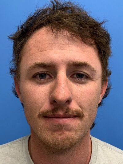 Chin Augmentation