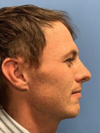 Chin Augmentation