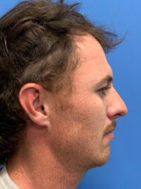 Chin Augmentation