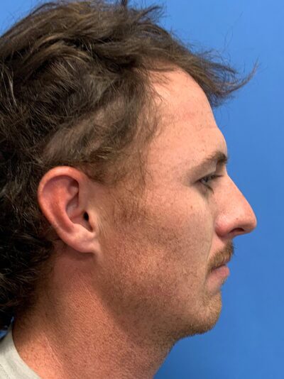 Chin Augmentation