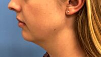 Chin Augmentation
