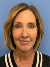Chin Augmentation