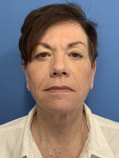 Face & Neck Lift Case 37590 After Photo Face & Neck Lift