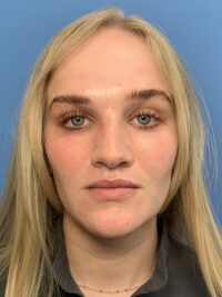 Rhinoplasty