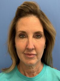 Chin Augmentation