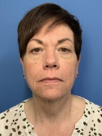 Face & Neck Lift