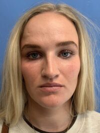 Rhinoplasty
