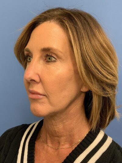 Chin Augmentation
