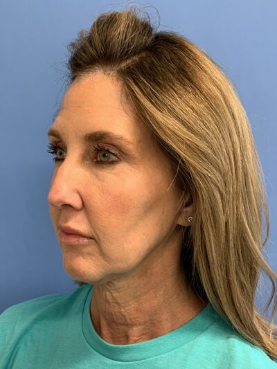 Chin Augmentation