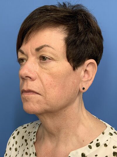 Face & Neck Lift Case 37590 Before Photo Face & Neck Lift