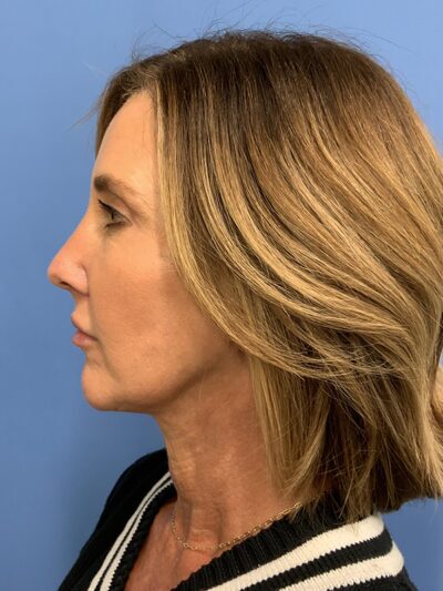 Chin Augmentation