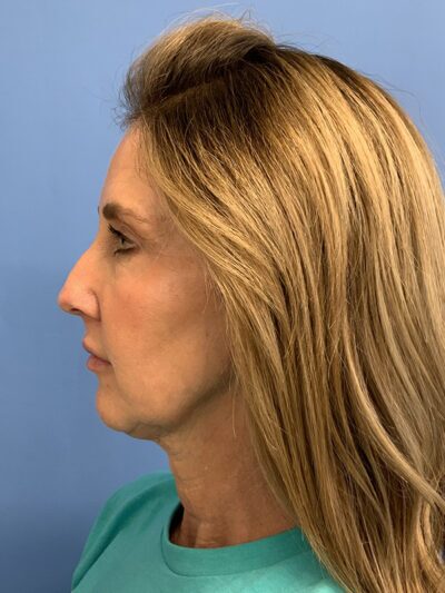 Chin Augmentation
