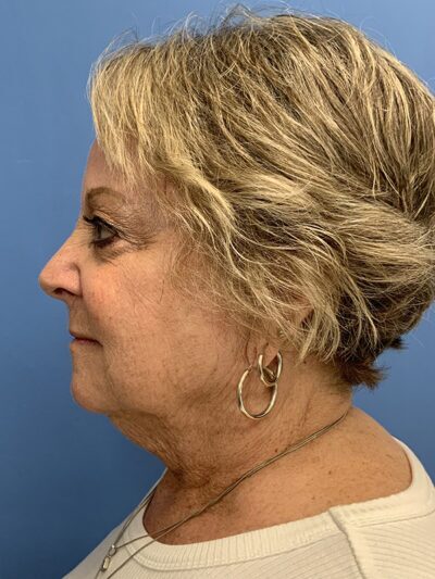 Face & Neck Lift