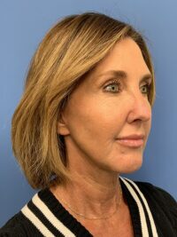 Face & Neck Lift