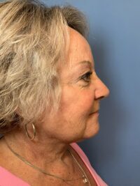 Face & Neck Lift