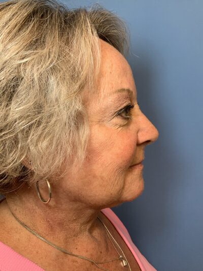Face & Neck Lift