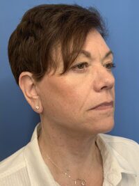 Face & Neck Lift