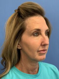 Face & Neck Lift
