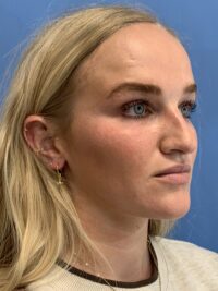 Rhinoplasty