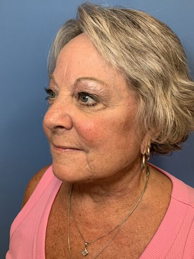 Face & Neck Lift