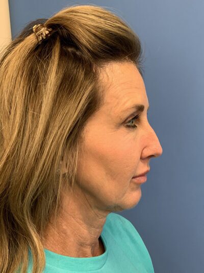 Chin Augmentation