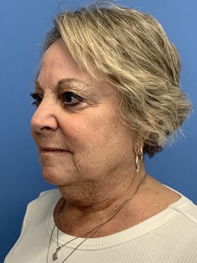Face & Neck Lift